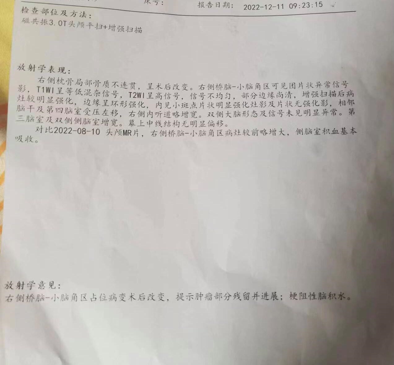 梗阻性脑积水